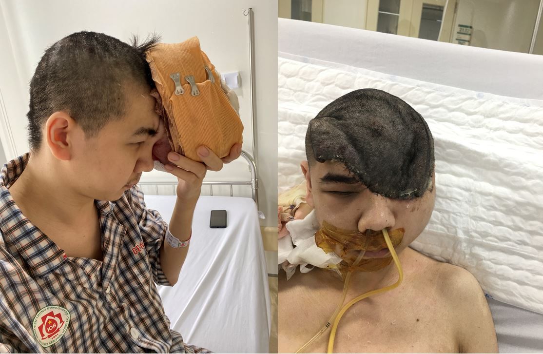 Nốt sùi nhỏ - tai hoạ lớn - Bệnh viện 108