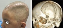Phẫu thuật tạo hình khuyết hổng xương sọ - Bệnh viện 108