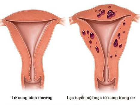 Lạc tuyến nội mạc tử cung trong cơ tử cung (bệnh cơ tuyến tử cung) - Bệnh viện 108