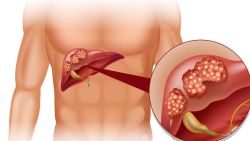 Vệ sinh nguồn nước, thực phẩm, ăn chín, uống sôi cần được lưu ý để đề phòng bệnh Viêm gan E - Bệnh viện 108