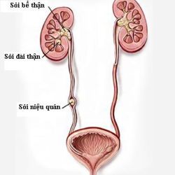 Những biến chứng khó lường của sỏi niệu quản - Bệnh viện 108