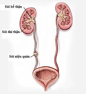 Những biến chứng khó lường của sỏi niệu quản - Bệnh viện 108