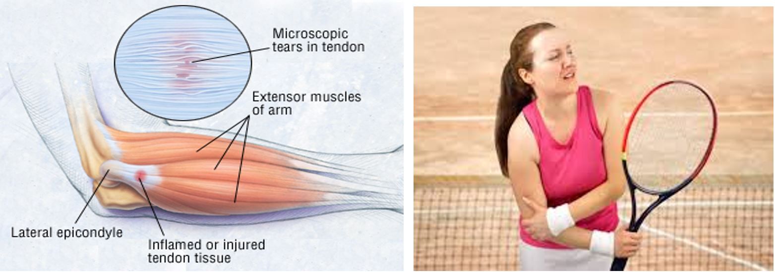 Hội chứng khuỷu tay Tennis (tennis elbow) - Bệnh viện 108