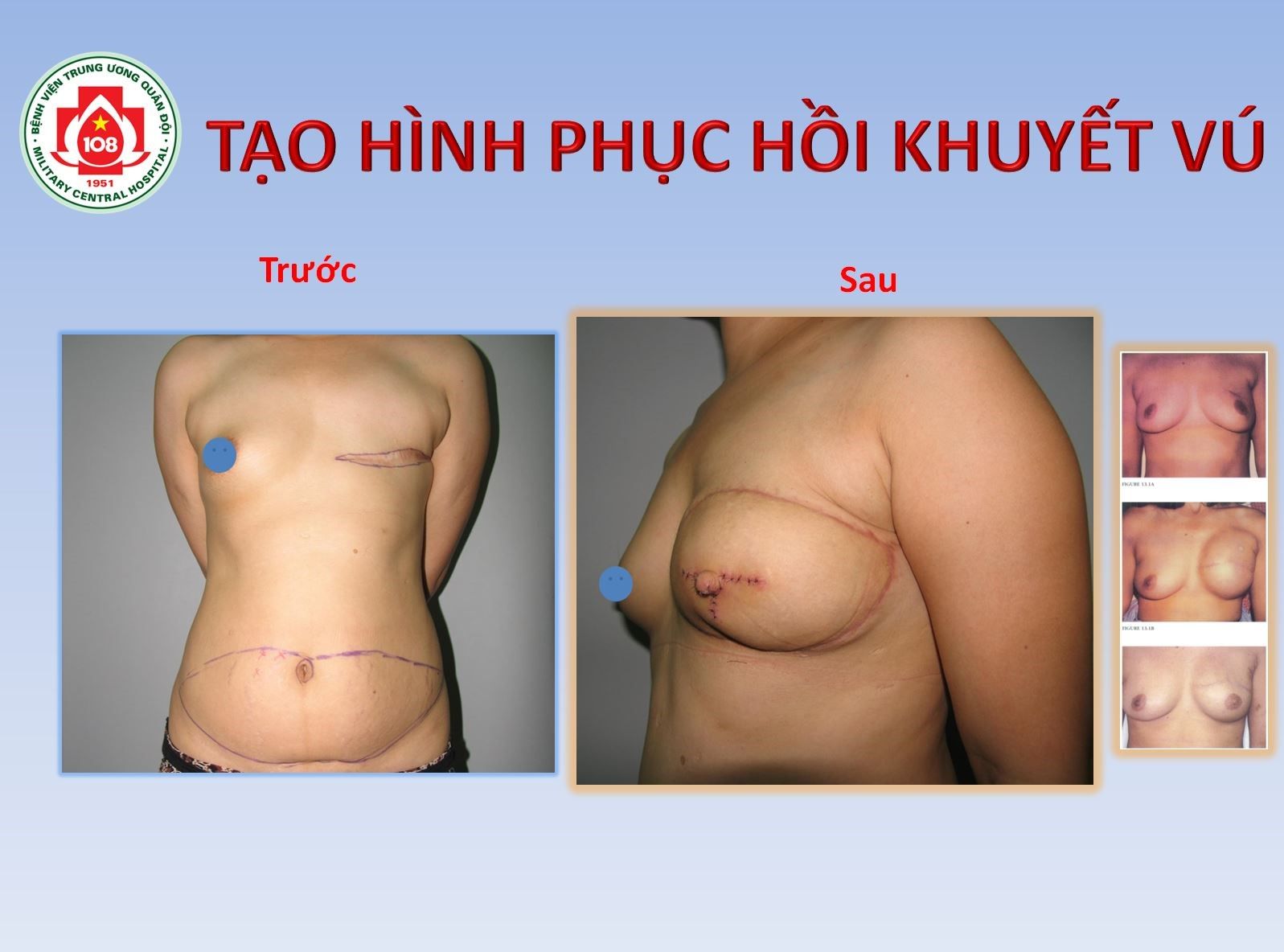 Khuyết vú- không phải là tuyệt vọng - Bệnh viện 108