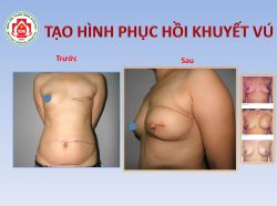Khuyết vú- không phải là tuyệt vọng - Bệnh viện 108