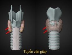 Siêu âm u tuyến cận giáp - bệnh viện 108