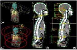 Xạ trị toàn não-tủy dưới gây mê cho bệnh nhân nhi bị u nguyên bào tủy - Bệnh viện 108