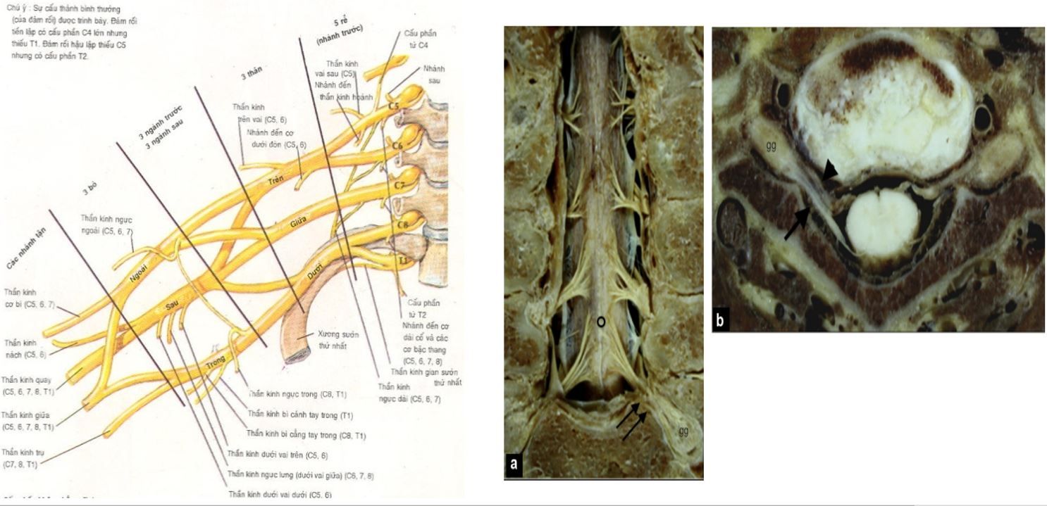 Giá trị chẩn đoán của cộng hưởng từ trong tổn thương đám rối thần kinh cánh tay do chấn thương - Bệnh viện 108