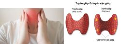 U tuyến cận giáp - Bệnh viện 108