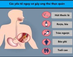 Các yếu tố nguy cơ ung thư thực quản - Bệnh viện 108