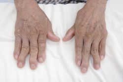 Các triệu chứng thường thấy của bệnh viêm khớp dạng thấp - Bệnh viện 108