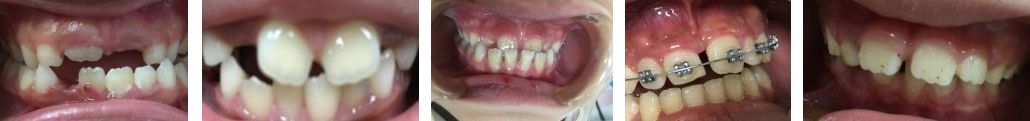 Lệch lạc răng và khớp cắn do phanh môi bám thấp ở trẻ: Phát hiện và xử trí - Bệnh viện 108