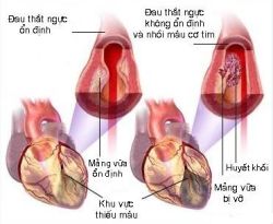 Bệnh động mạch vành, cơn đau thắt ngực & nhồi máu cơ tim - Bệnh viện 108