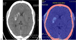 Giá trị của Cắt lớp vi tính phổ 512 dãy trong can thiệp mạch máu não - Bệnh viện 108