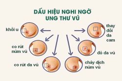 Ung thư vú: phát hiện sớm bệnh có thể điều trị khỏi! - Bệnh viện 108