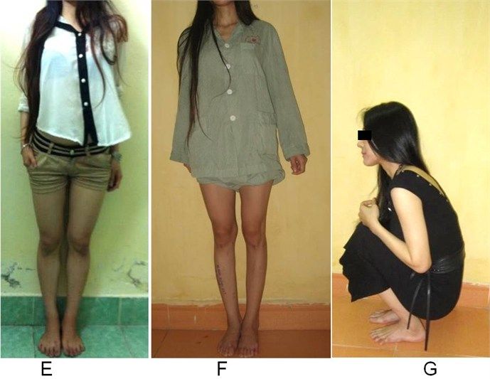Một số điều cần biết về kéo dài chân, nâng chiều cao - Bệnh viện 108