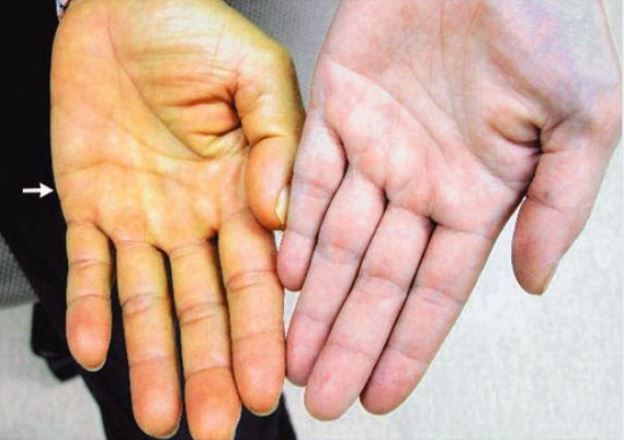 Giật mình trước 4 dấu hiệu nhận biết viêm gan C sớm