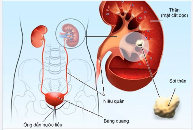 5 DẤU HIỆU CẢNH BÁO SỎI THẬN CẦN CAN THIỆP NGAY