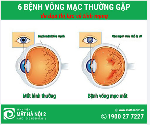 6 bệnh võng mạc thường gặp nhất hiện nay