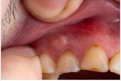 ÁP XE RĂNG CÓ PHẢI LÀ MỘT BỆNH LÝ NGUY HIỂM KHÔNG?
