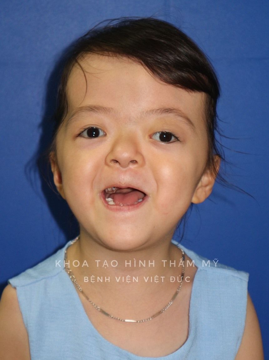 Điều trị thành công hội chứng hẹp hộp sọ phức tạp (Apert’s Syndrome) hiếm có trên thế giới - Bệnh viện Việt Đức