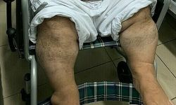 Lần đầu tiên ở Việt Nam phẫu thuật bắc cầu động mạch vành cho người bệnh lùn bẩm sinh và béo phì