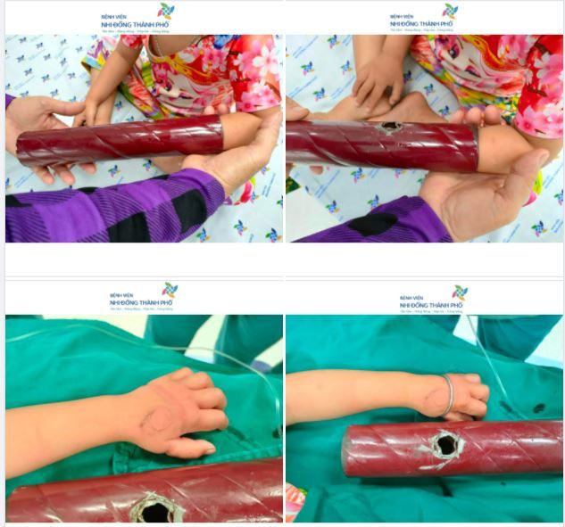Bé gái 3 tuổi vô tình biến thành "NGƯỜI SẮT" khi bị kẹt cánh tay vào chân giương