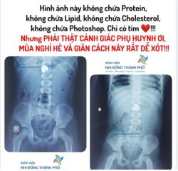 Bé gái 4 tuổi ở Sóc Trăng cầm chơi xong nuốt luôn mặt dây chuyền hình trái tim