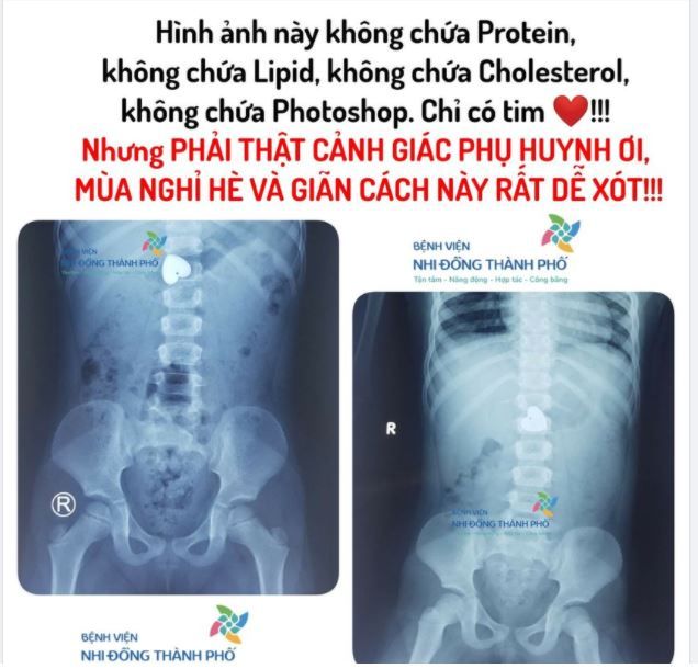 Bé gái 4 tuổi ở Sóc Trăng cầm chơi xong nuốt luôn mặt dây chuyền hình trái tim