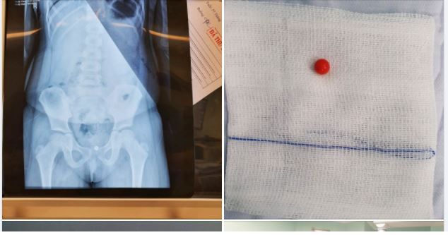 NGHỊCH ĐƯA VIÊN BI VÀO VÙNG KÍN KHÔNG LẤY RA ĐƯỢC, BÉ GÁI 5 TUỔI KỊP THỜI ĐƯỢC NỘI SOI GẮP RA