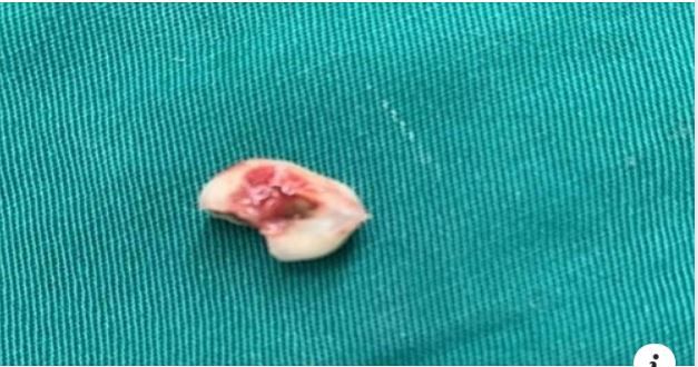 BÉ GÁI SUÝT TẮC ĐƯỜNG THỞ SAU KHI NHỔ RĂNG VÀ BỊ HÓC VÀO PHẾ QUẢN