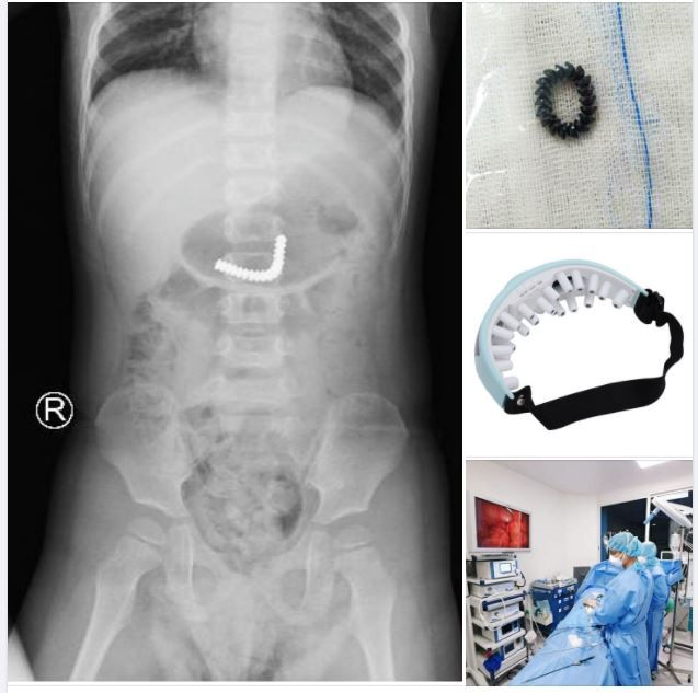 BÉ TRAI PHẢI CẮT NỐI RUỘT DO NUỐT 18 VIÊN NAM CHÂM TỪ MÁY MÁT XA MẮT CỦA MẸ