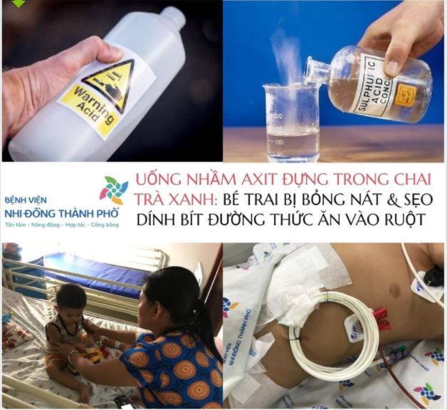 BÉ TRAI UỐNG NHẦM AXIT SUNFURIC  DO NGƯỜI NHÀ CHỨA TRONG CHAI TRÀ XANH, BỊ BỎNG CHÍT HẸP ĐƯỜNG ĂN, ĐỐI DIỆN NGUY CƠ PHẢI CẮT BỎ MÔN VỊ