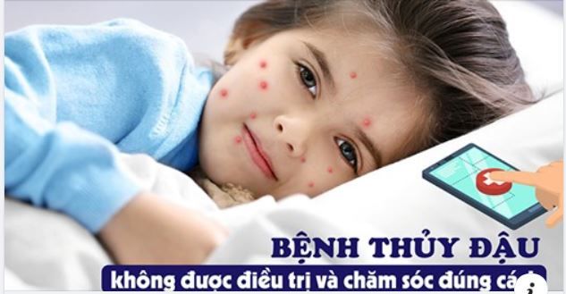 BỆNH THỦY ĐẬU: SAI LẦM TRONG ĐIỀU TRỊ CÓ THỂ DẪN ĐẾN BIẾN CHỨNG. NÊN KIÊNG GÌ, BÔI THUỐC GÌ ĐỂ NHANH KHỎI VÀ KHÔNG ĐỂ LẠI SẸO?