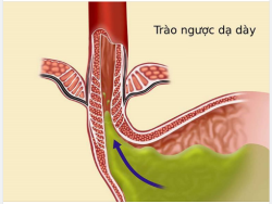 BỆNH TRÀO NGƯỢC DẠ DÀY THỰC QUẢN THƯỜNG GẶP NHƯNG KHÔNG HỀ ĐƠN GIẢN