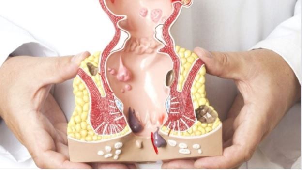 BỆNH TRĨ: KHI NÀO CẦN PHẢI MỔ?