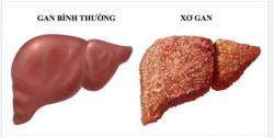 BỆNH XƠ GAN - KHÓ CHỮA NHƯNG DỄ PHÒNG