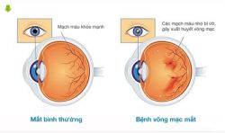 Biến chứng thường gặp ở mắt do TIỂU_ĐƯỜNG
