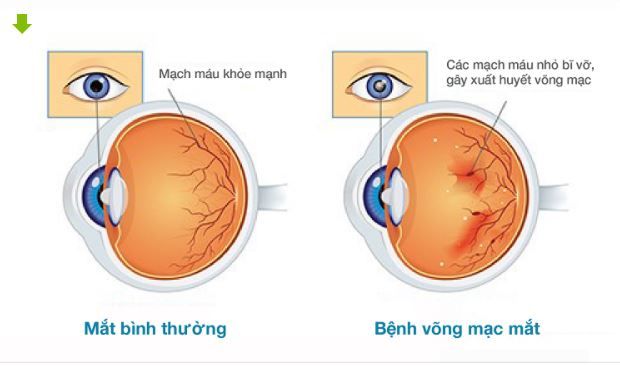 Biến chứng thường gặp ở mắt do TIỂU_ĐƯỜNG