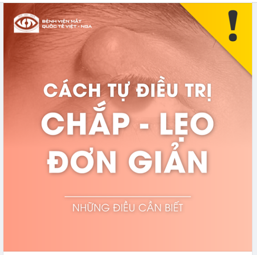 CÁCH TỰ ĐIỀU TRỊ CHẮP - LẸO ĐƠN GIẢN