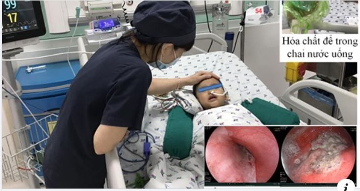 Cứu sống một trường hợp trẻ ngộ độc hóa chất chống thấm ghe xuồng