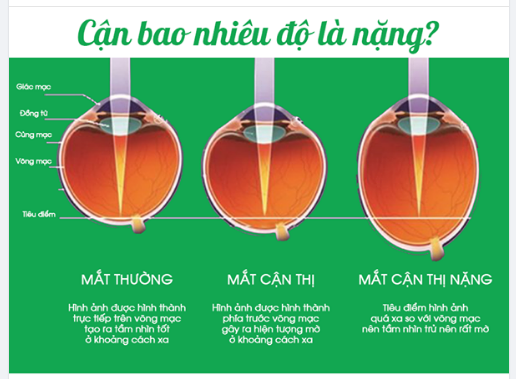 Cận thị bao nhiêu độ là nặng​​​​​​​ Cận thị nặng thì sao