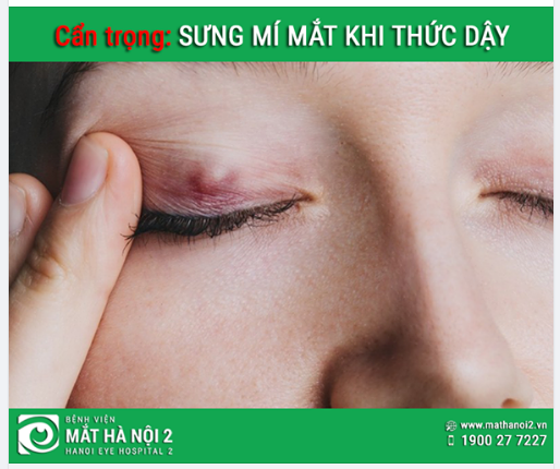 CẨN TRỌNG: Sưng mí mắt khi thức dậy dấu hiệu bạn đang mắc phải chứng bệnh nguy hiểm