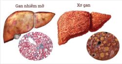 CẨN TRỌNG TRƯỚC NHỮNG TRIỆU CHỨNG GAN NHIỄM MỠ  NGẤP NGHÉ XƠ GAN