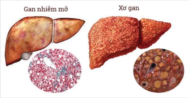 CẨN TRỌNG TRƯỚC NHỮNG TRIỆU CHỨNG GAN NHIỄM MỠ  NGẤP NGHÉ XƠ GAN