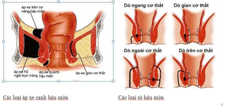 Bệnh áp xe hậu môn và rò hậu môn-  Bệnh Viện Việt Đức