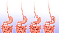 Những điều cần biết về phẫu thuật cắt vạt dạ dày để giảm cân
