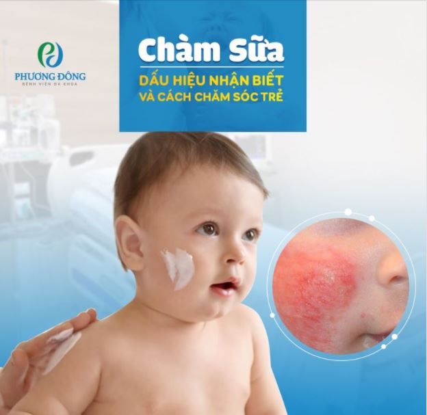 Chàm sữa - Dấu hiệu nhận biết và cách chăm sóc trẻ