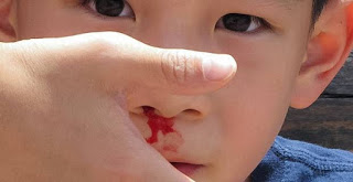 Chảy máu cam ở trẻ em và cách xử trí - Bệnh viện nhi Trung Ương