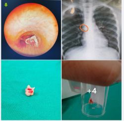 ĐIỀU KHÔNG AI MONG MUỐN LẠI XẢY RA, HÔM QUA LÀ HẠT DƯA, HÔM NAY LÀ CHIẾC RĂNG MẸ TỪNG NHỔ CHO CON TẠI NHÀ!!